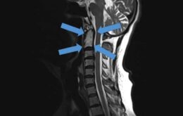 Cirurgia implanta vértebras impressas em 3D pela primeira vez