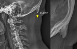 Estudo que apontava ‘chifre’ causado por uso de celular estava incorreto