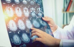 Cientistas desenvolvem scanner para tratar doenças cerebrais