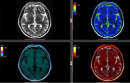 Centros de pesquisa querem ensinar IA a identificar tumores cerebrais