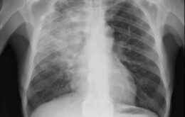 Aplicativo da USP identifica Covid-19 em radiografias de pulmões